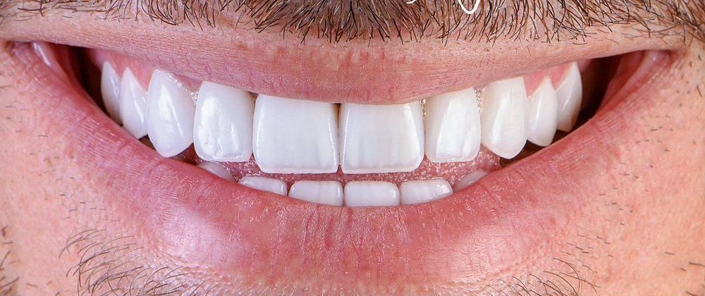 The same man’s smile with veneers
