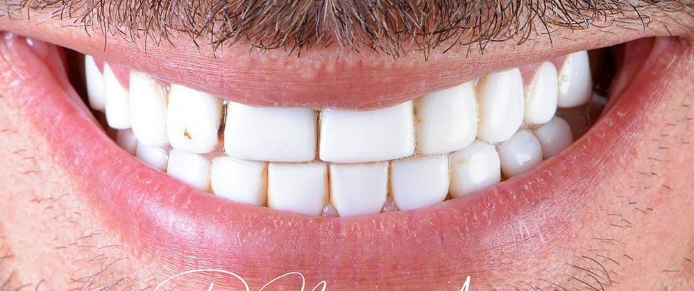 A man’s smile before treatment