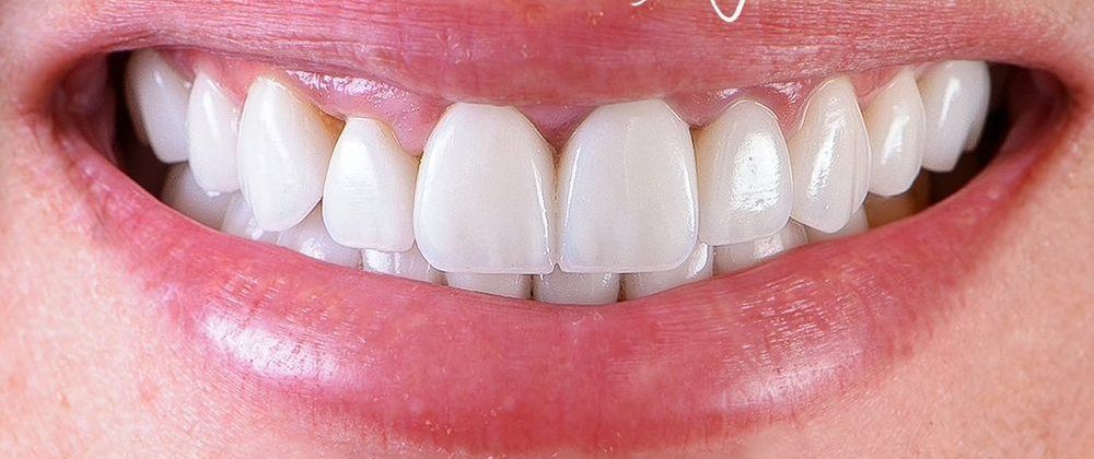The same woman’s smile with veneers