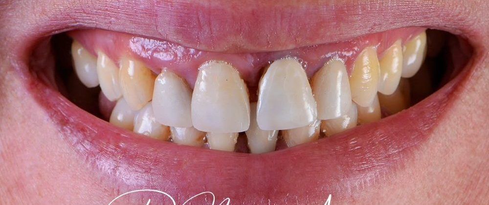 A woman’s smile with gaps and uneven teeth before treatment