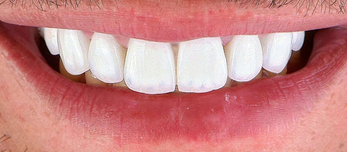 A finished smile with veneers at the clinic