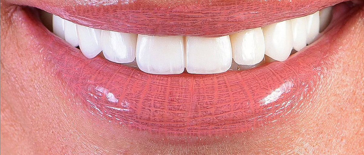 A restored smile at the clinic